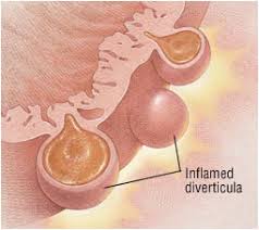 Diverticolite della vescica nella Sindrome di Williams
